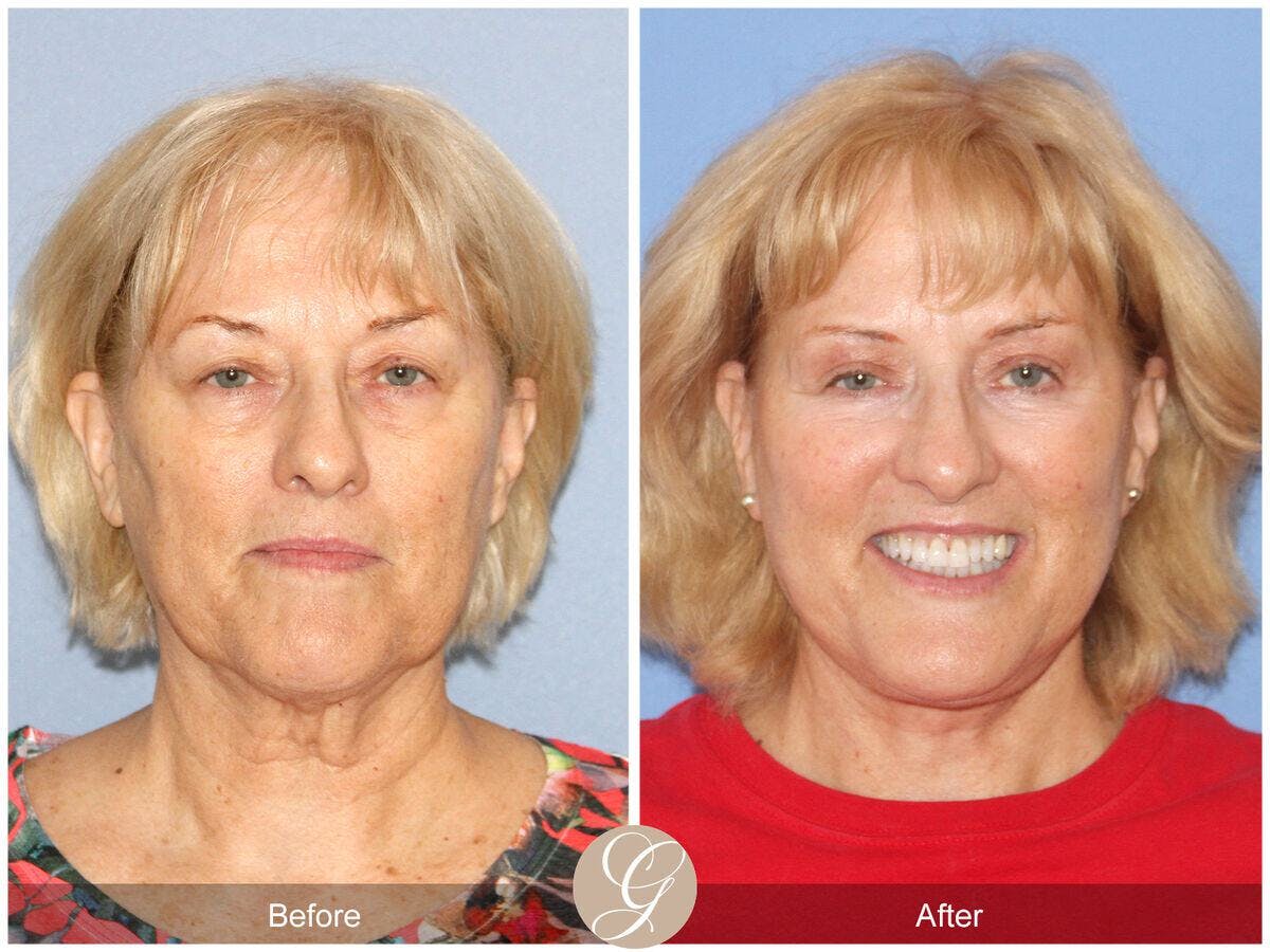 Facelift 60s Before & After Gallery - Patient 267079 - Image 2