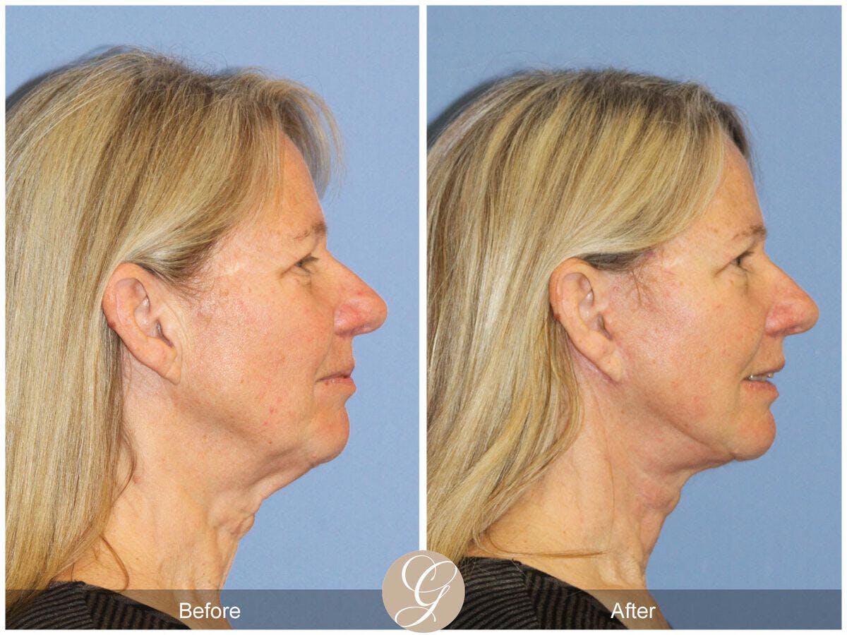Facelift 60s Before & After Gallery - Patient 210319 - Image 3