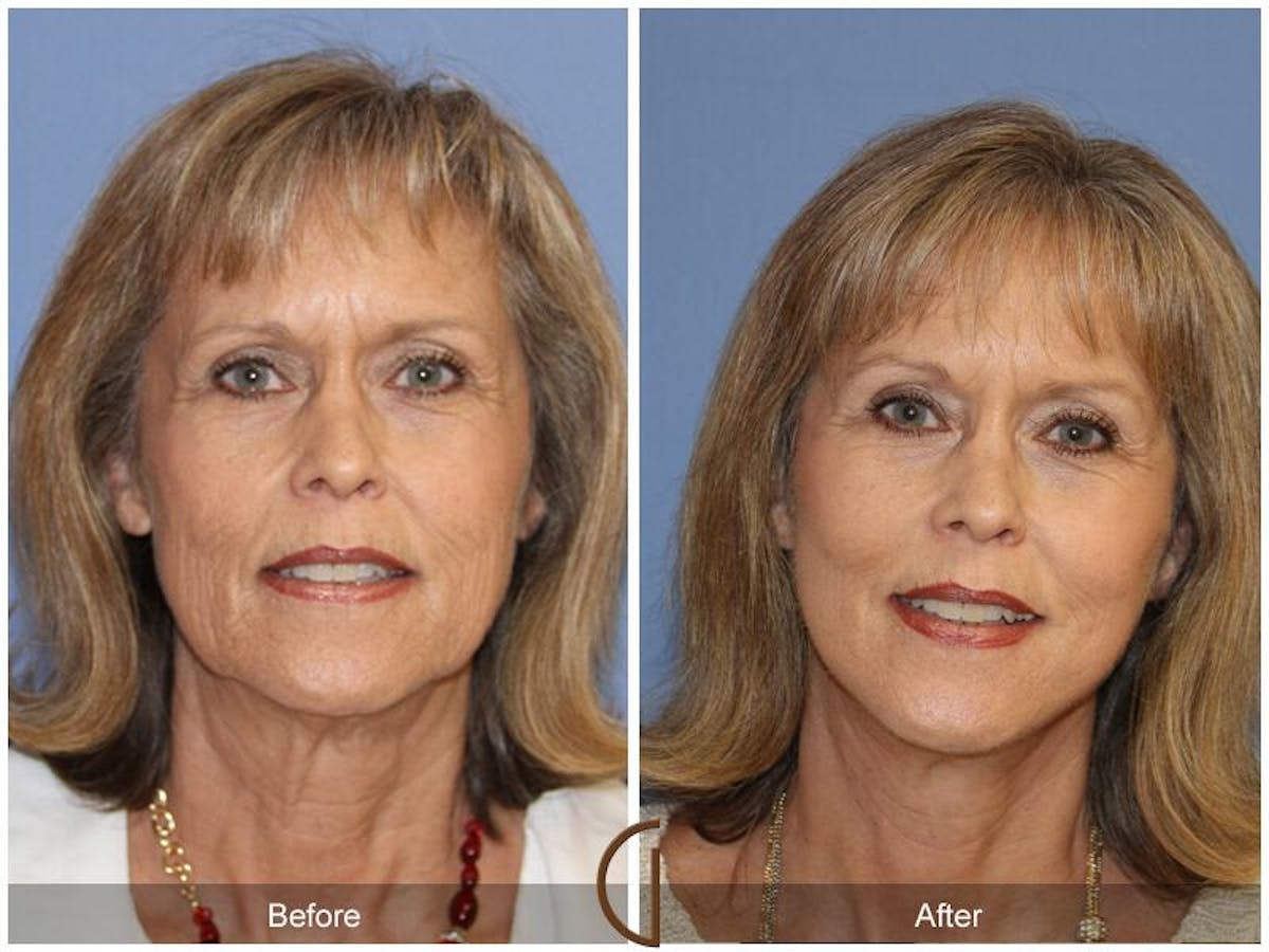 Facelift 60s Before & After Gallery - Patient 197943 - Image 2
