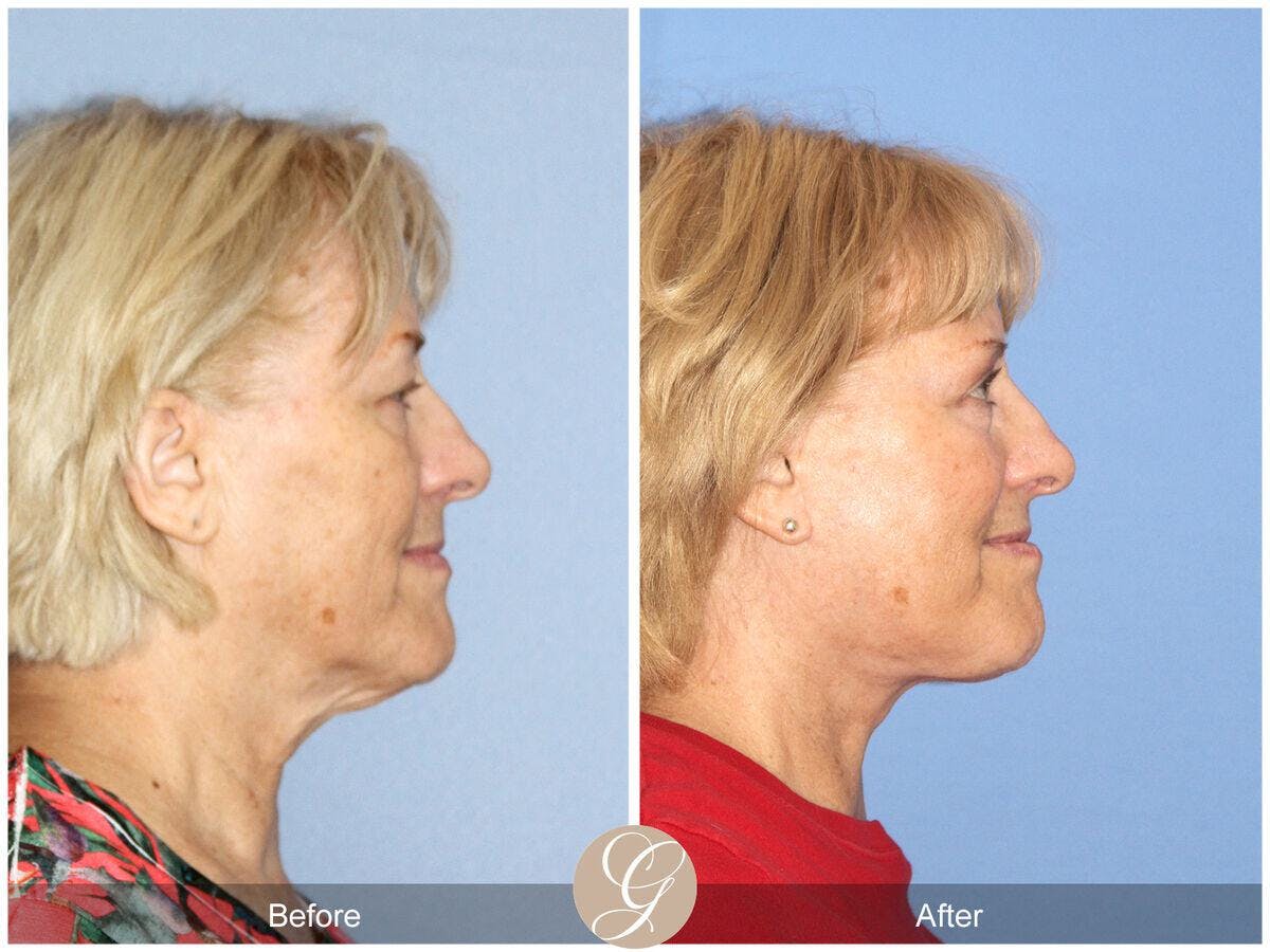 Facelift 60s Before & After Gallery - Patient 267079 - Image 3