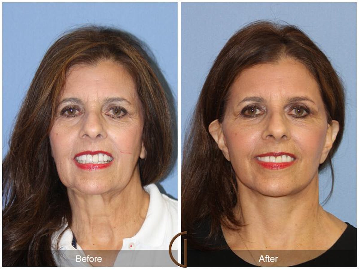 Facelift 60s Before & After Gallery - Patient 225974 - Image 2
