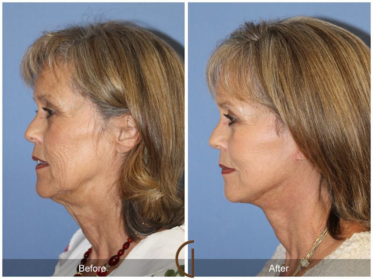 Facelift 60s Before & After Gallery - Patient 197943 - Image 1