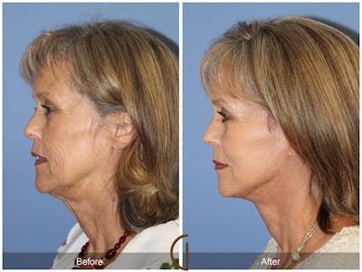 Facelift 60s Before & After Gallery - Patient 197943 - Image 1