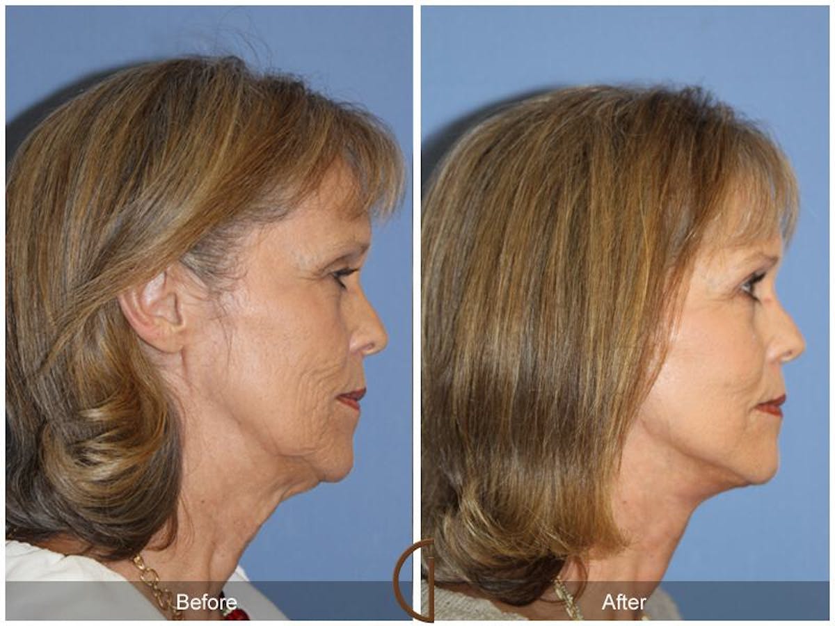 Facelift 60s Before & After Gallery - Patient 197943 - Image 3