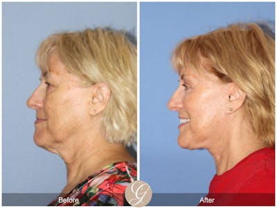 Facelift 60s Before & After Gallery - Patient 267079 - Image 1