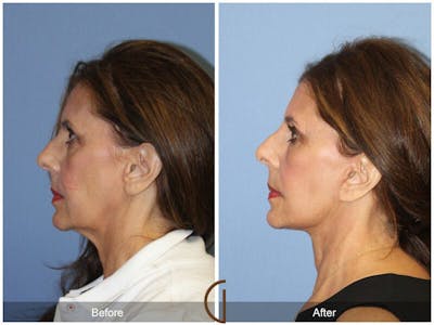 Facelift 60s Before & After Gallery - Patient 225974 - Image 1