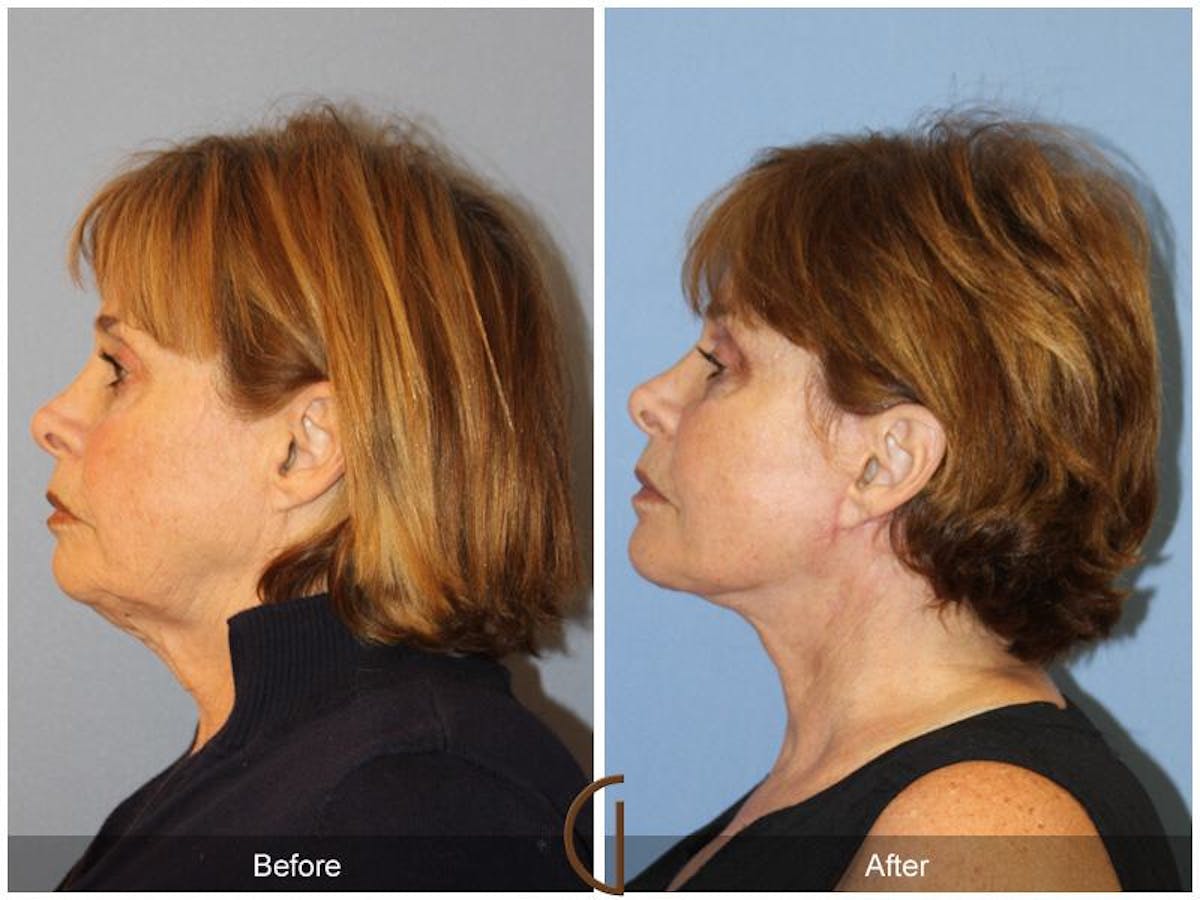 Facelift 60s Before & After Gallery - Patient 537398 - Image 1