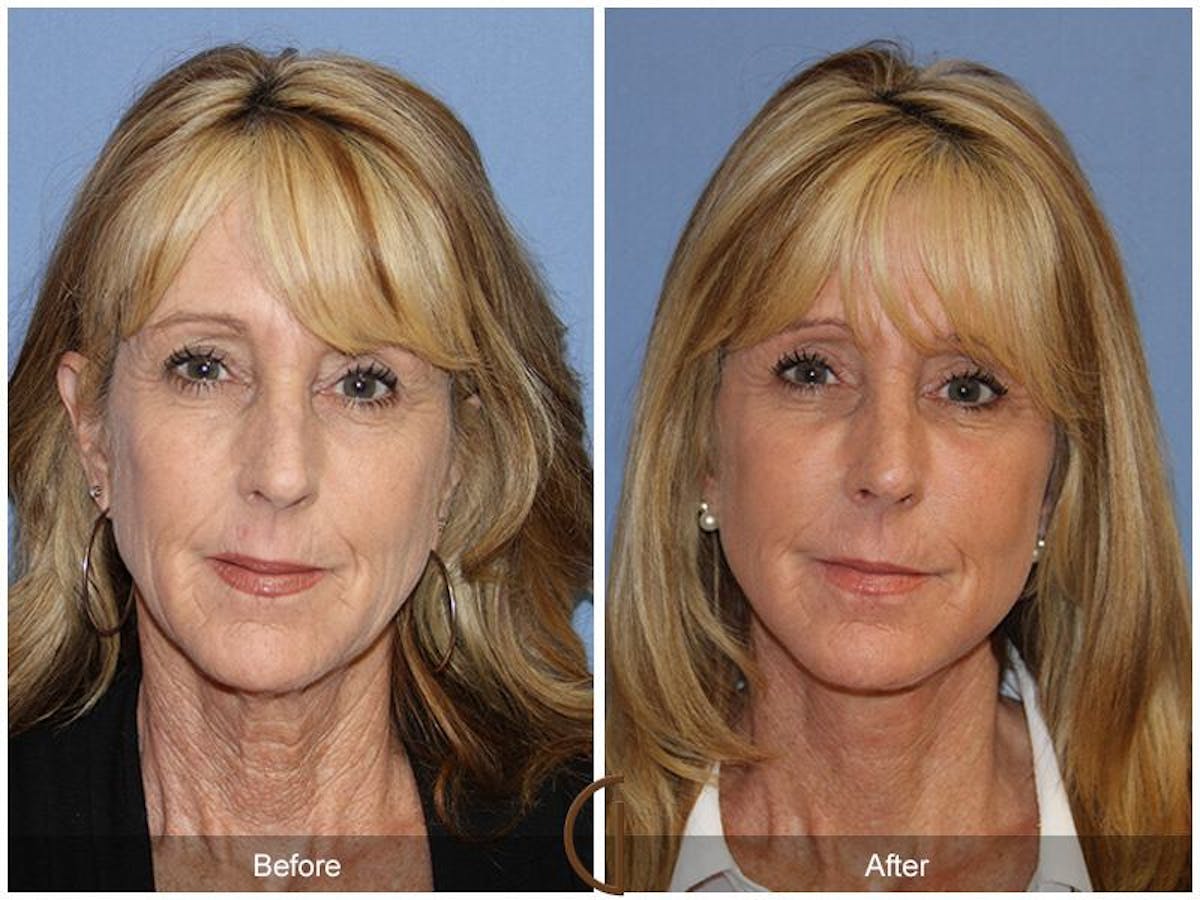Facelift 60s Before & After Gallery - Patient 297964 - Image 2