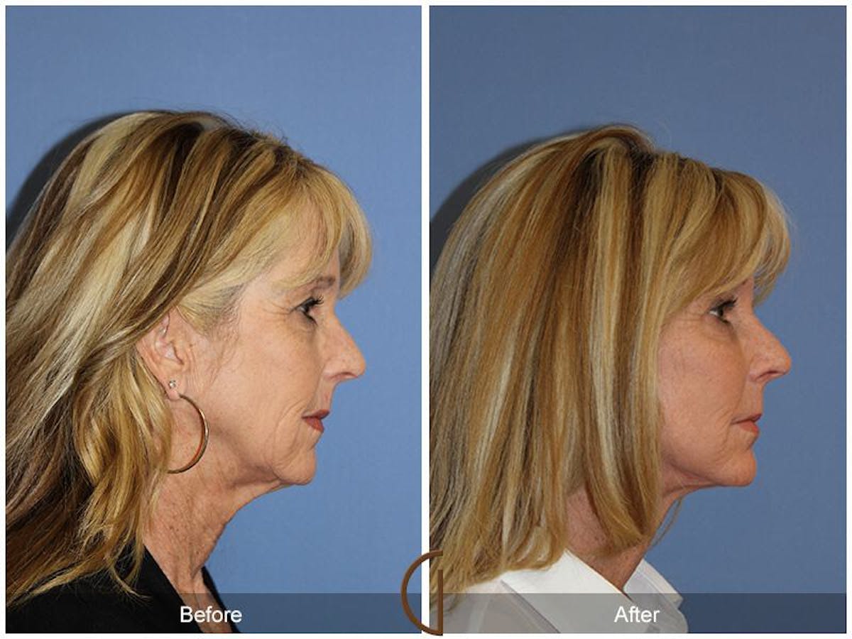 Facelift 60s Before & After Gallery - Patient 297964 - Image 3