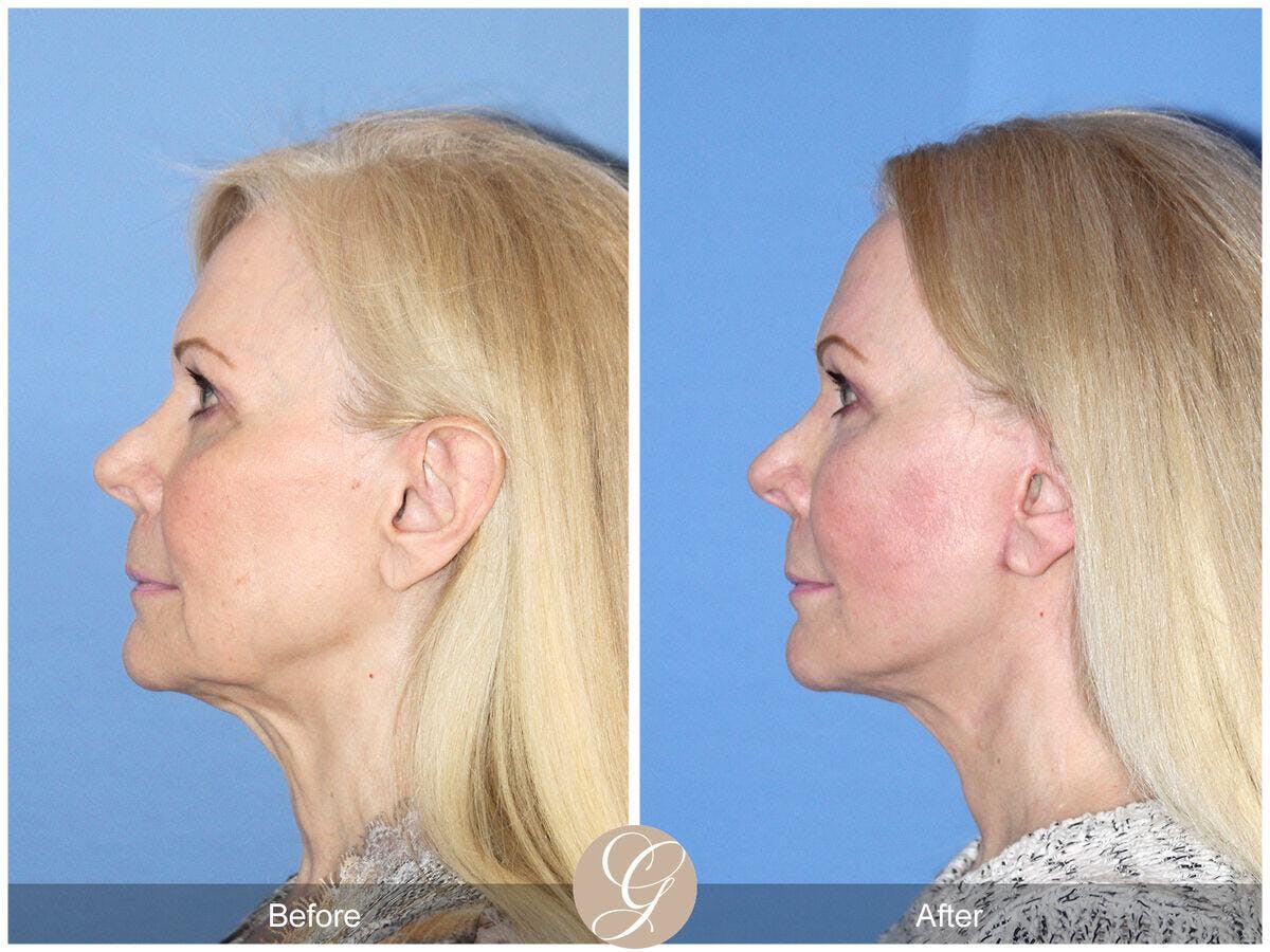 Facelift 60s Before & After Gallery - Patient 412955 - Image 1