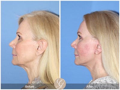 Facelift 60s Before & After Gallery - Patient 412955 - Image 1