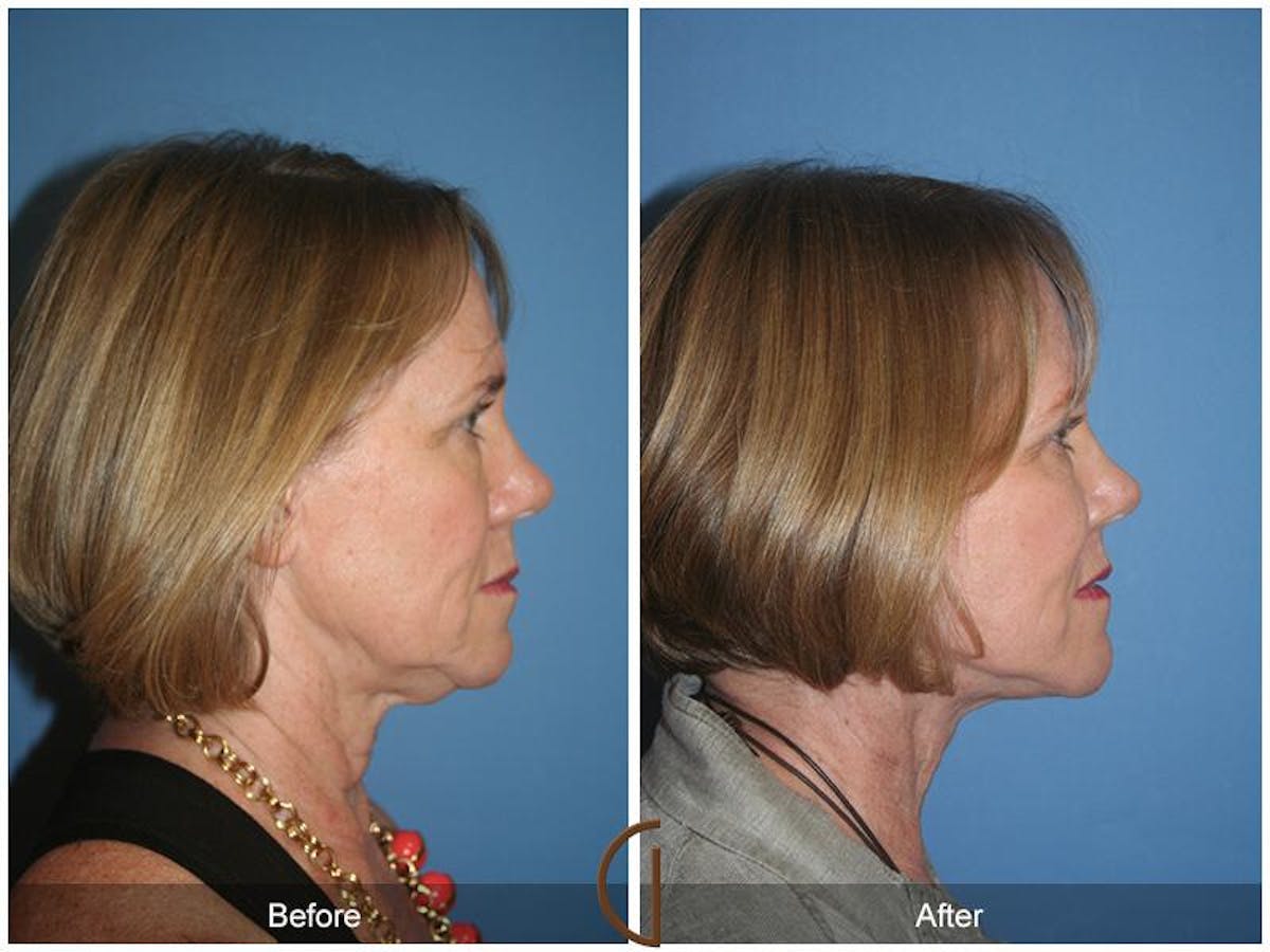 Facelift 60s Before & After Gallery - Patient 640807 - Image 3
