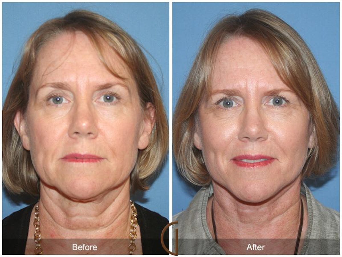 Facelift 60s Before & After Gallery - Patient 640807 - Image 2