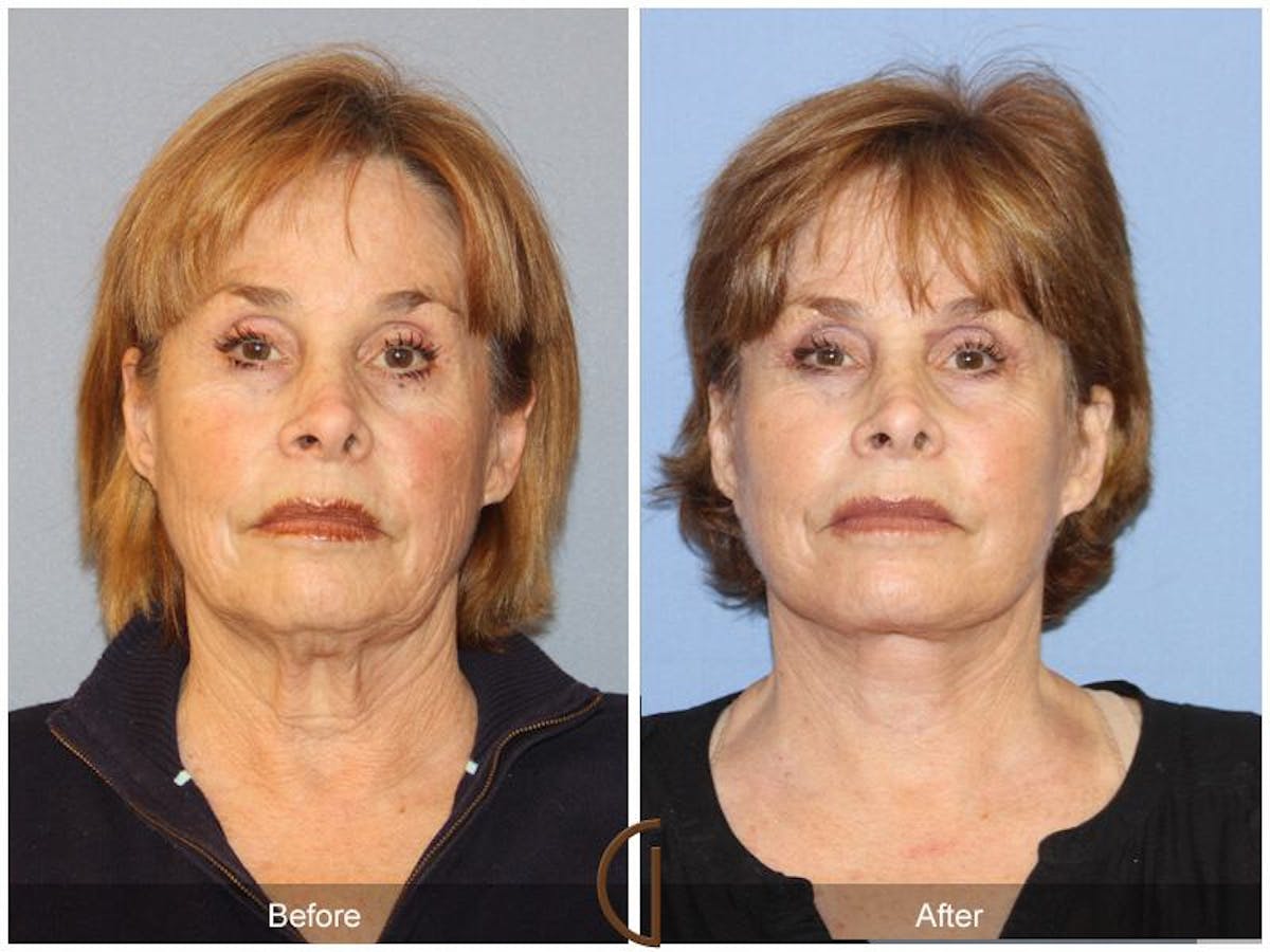 Facelift 60s Before & After Gallery - Patient 537398 - Image 2