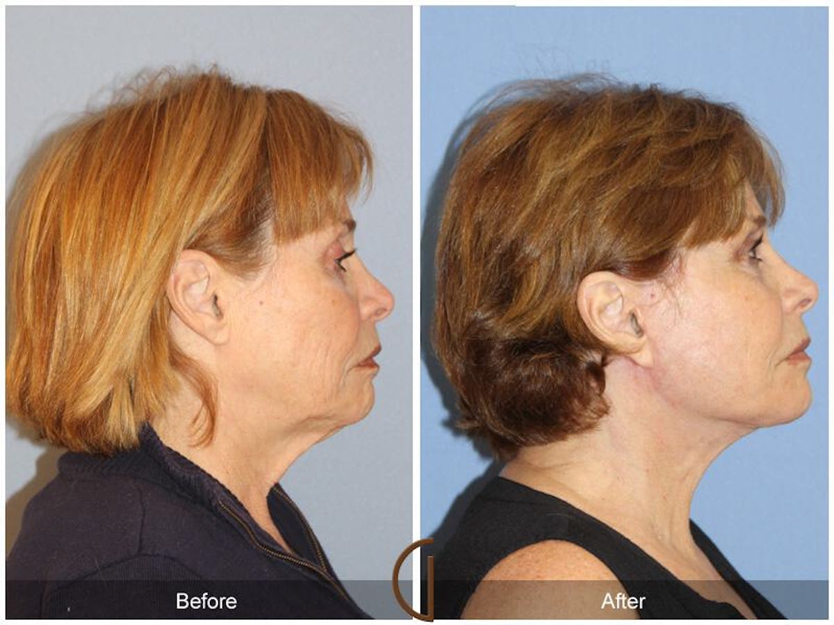 Facelift 60s Before & After Gallery - Patient 537398 - Image 3