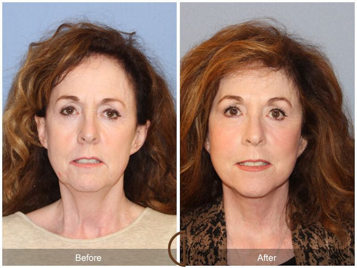 Facelift 60s Before & After Gallery - Patient 419844 - Image 2