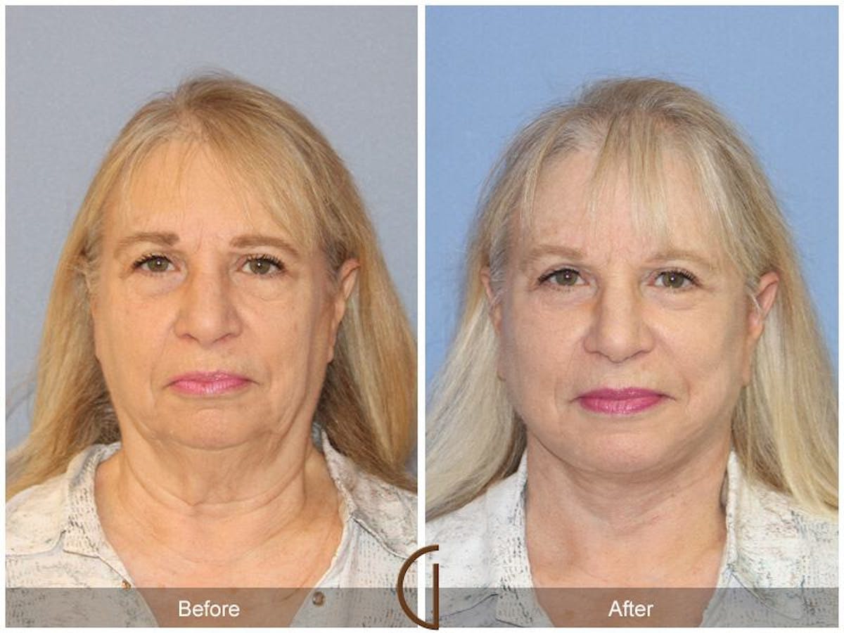 Facelift 60s Before & After Gallery - Patient 761421 - Image 2
