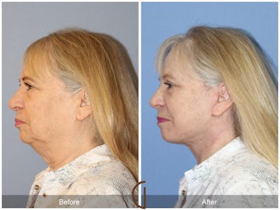 Facelift 60s Before & After Gallery - Patient 761421 - Image 1