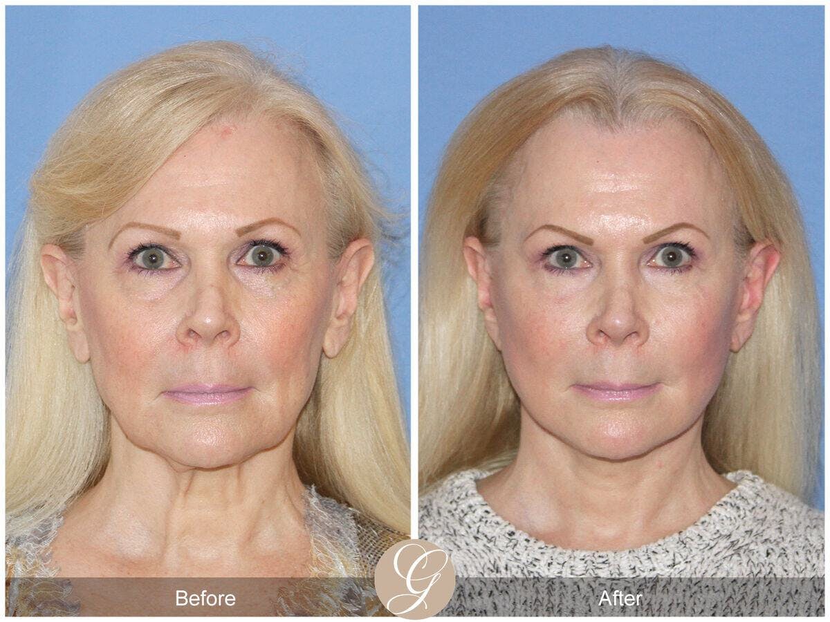 Facelift 60s Before & After Gallery - Patient 412955 - Image 2