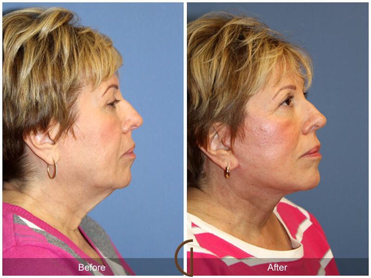 Facelift 60s Before & After Gallery - Patient 169448 - Image 3