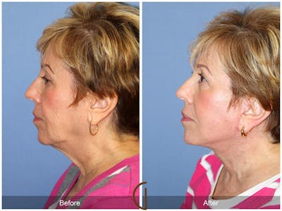 Facelift 60s Before & After Gallery - Patient 169448 - Image 1