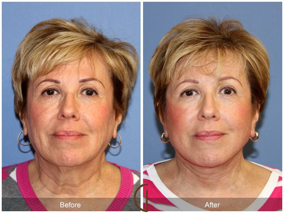 Facelift 60s Before & After Gallery - Patient 169448 - Image 2