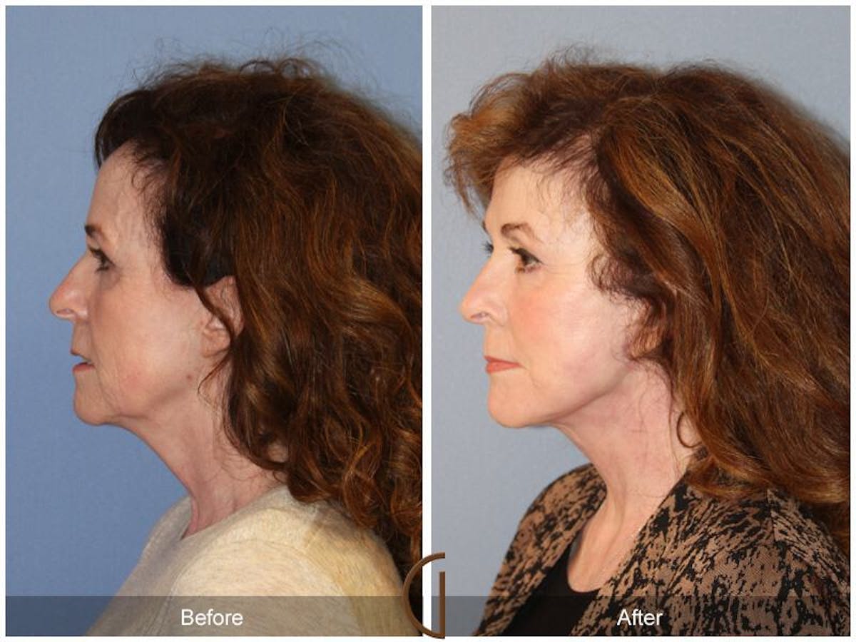 Facelift 60s Before & After Gallery - Patient 419844 - Image 1