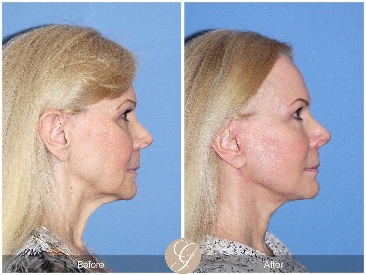 Facelift 60s Before & After Gallery - Patient 412955 - Image 3