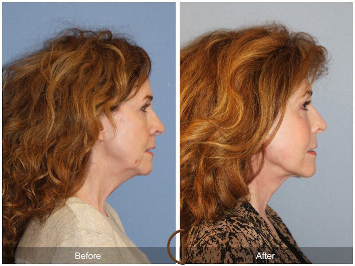 Facelift 60s Before & After Gallery - Patient 419844 - Image 3