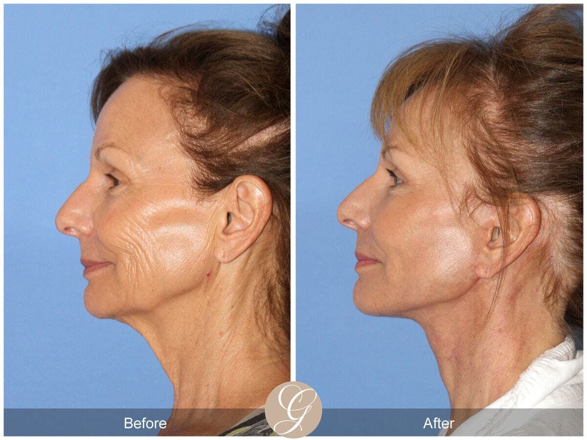 Facelift 60s Before & After Gallery - Patient 181628 - Image 1