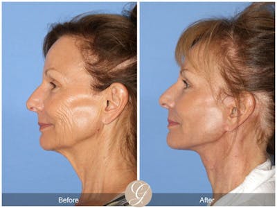 Facelift 60s Before & After Gallery - Patient 181628 - Image 1