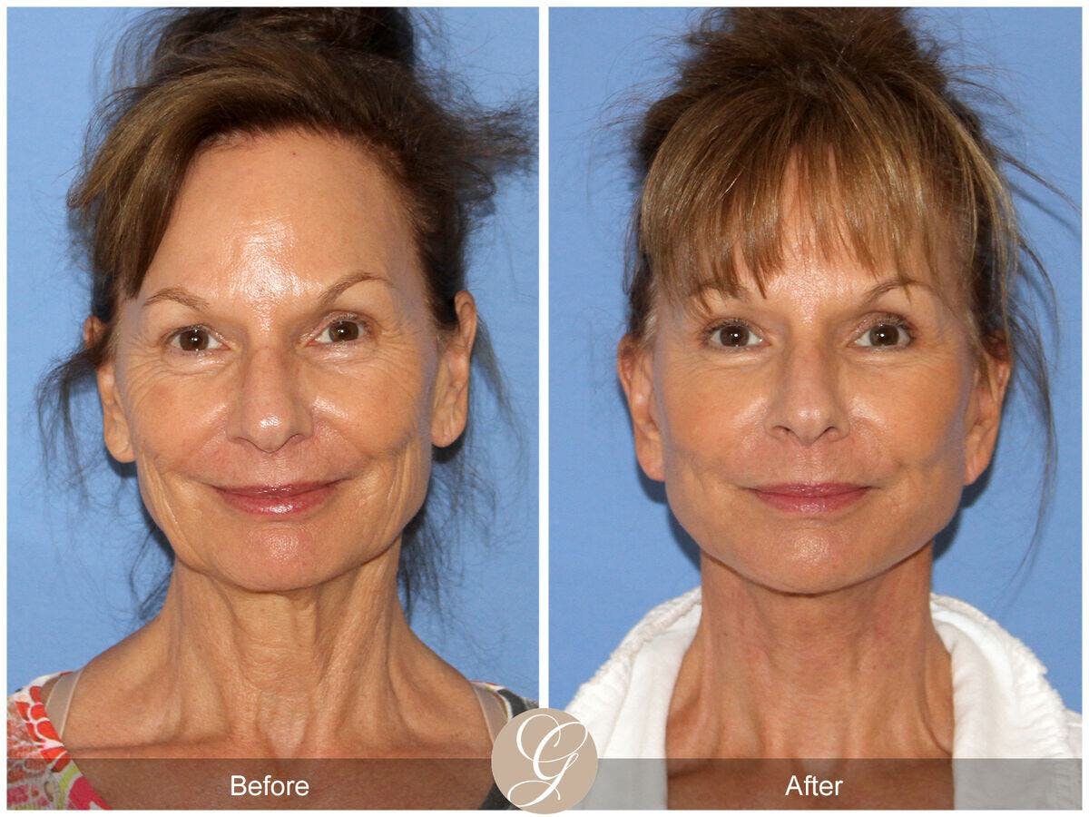 Facelift 60s Before & After Gallery - Patient 181628 - Image 2