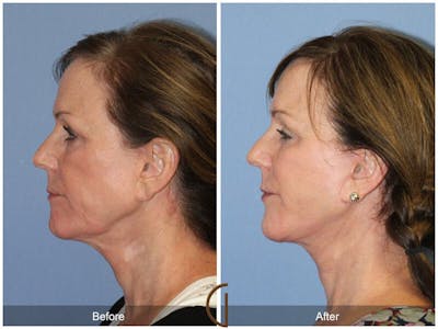 Facelift 60s Before & After Gallery - Patient 289263 - Image 1