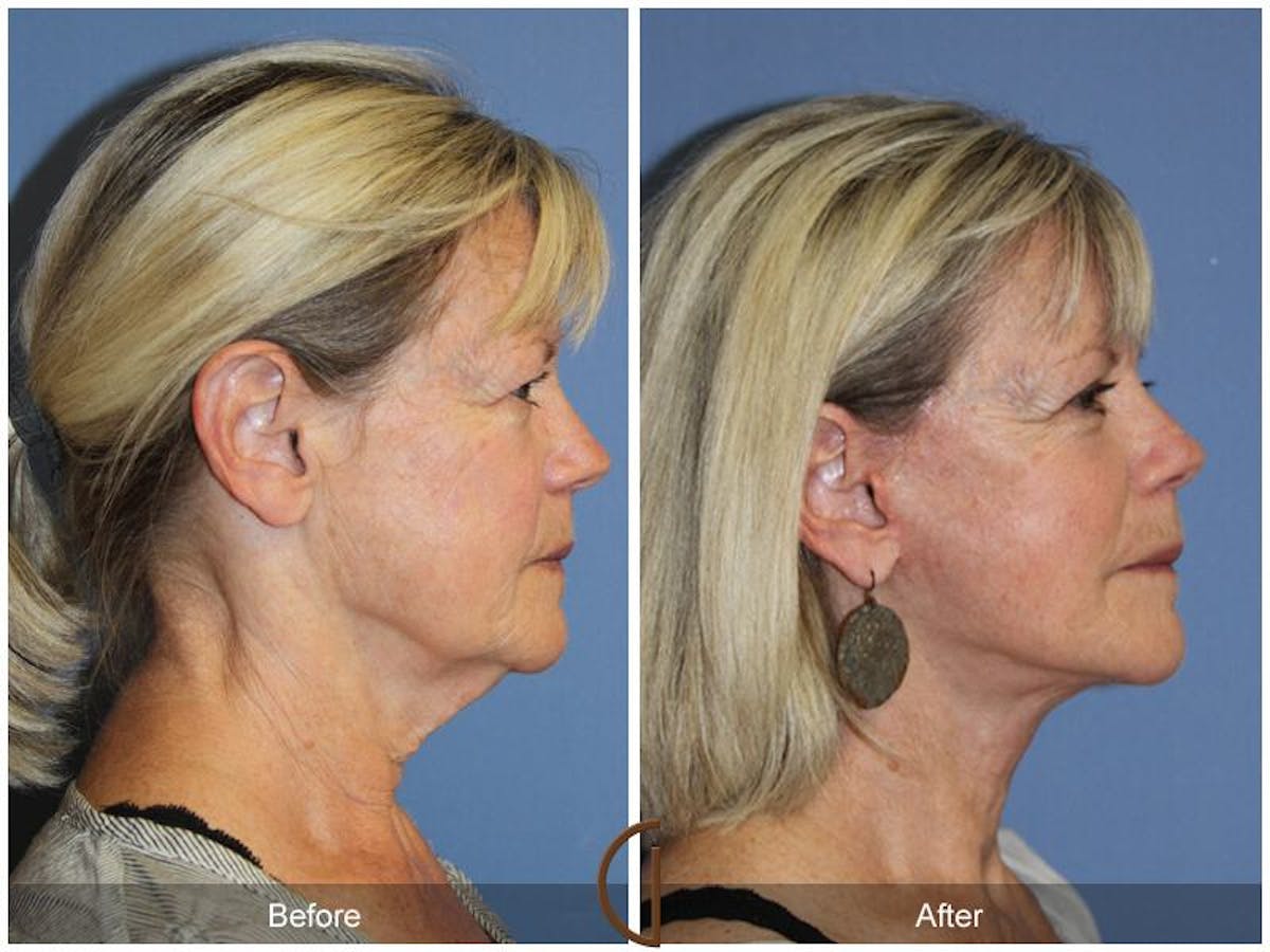 Facelift 60s Before & After Gallery - Patient 351200 - Image 3