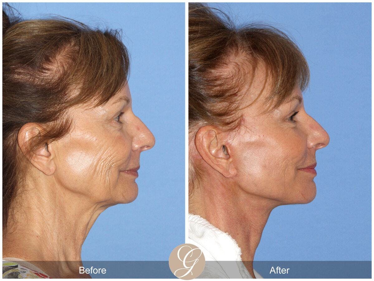 Facelift 60s Before & After Gallery - Patient 181628 - Image 3