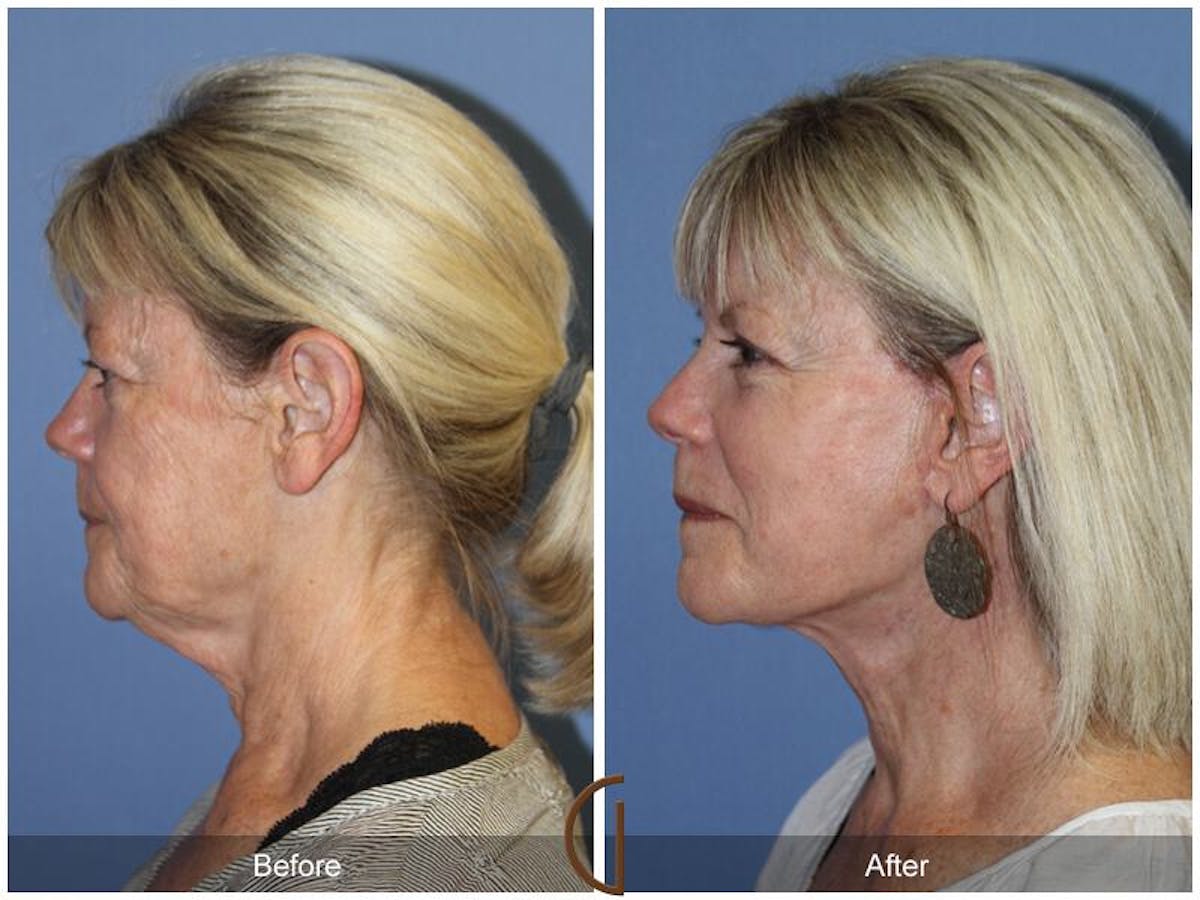 Facelift 60s Before & After Gallery - Patient 351200 - Image 1