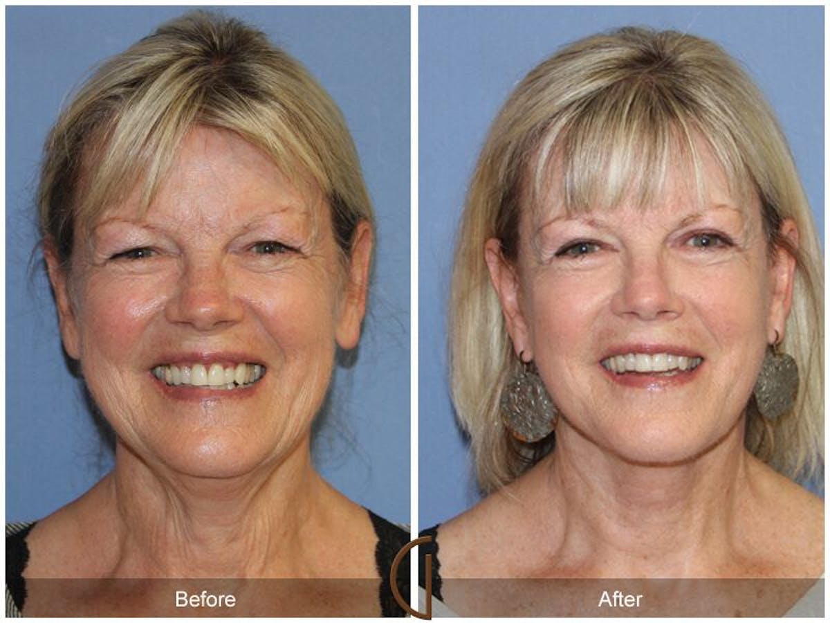 Facelift 60s Before & After Gallery - Patient 351200 - Image 2