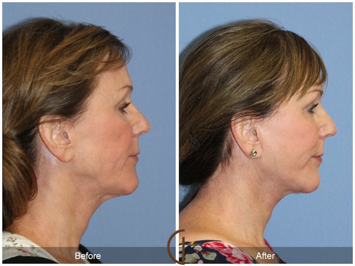 Facelift 60s Before & After Gallery - Patient 289263 - Image 3