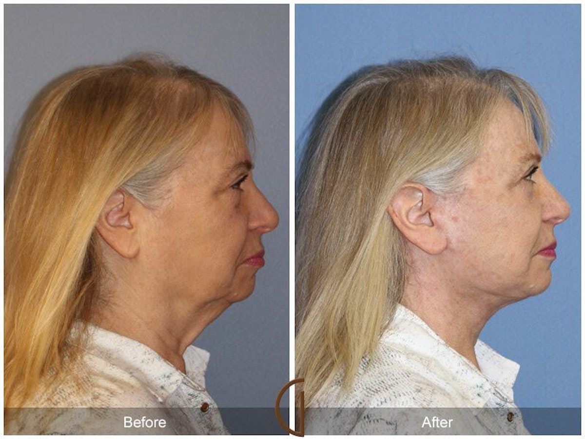 Facelift 60s Before & After Gallery - Patient 761421 - Image 3