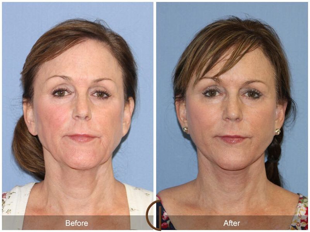 Facelift 60s Before & After Gallery - Patient 289263 - Image 2
