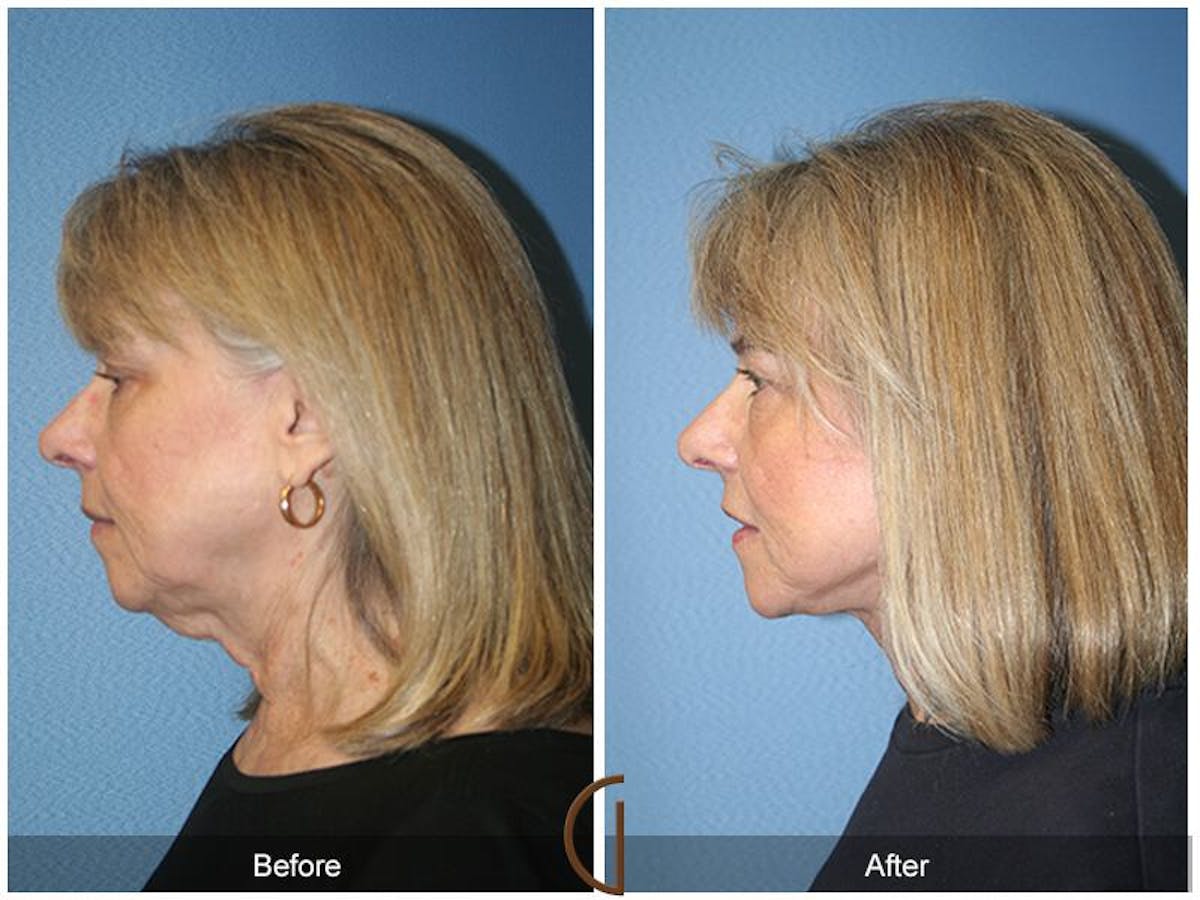 Facelift 60s Before & After Gallery - Patient 844708 - Image 1
