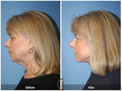 Facelift 60s Before & After Gallery - Patient 105079 - Image 1