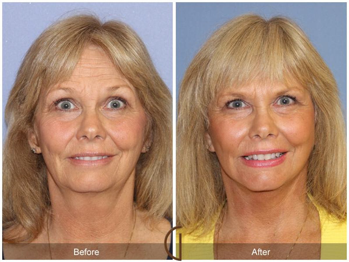 Facelift 60s Before & After Gallery - Patient 128015 - Image 2