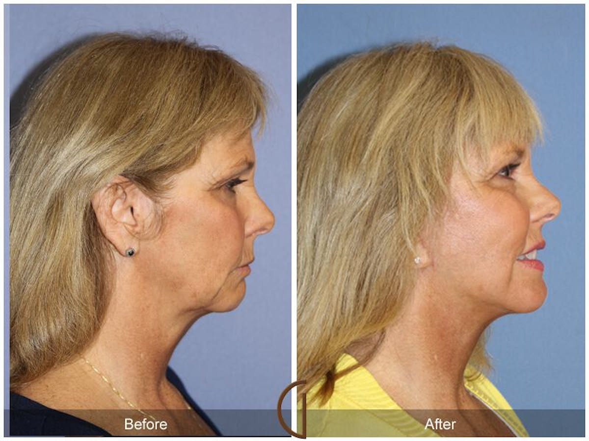 Facelift 60s Before & After Gallery - Patient 128015 - Image 3