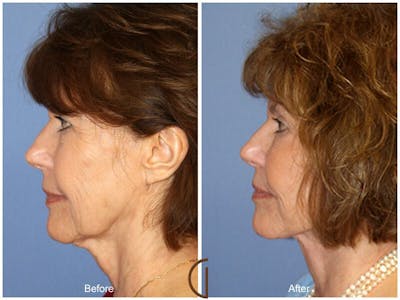 Facelift 60s Before & After Gallery - Patient 573048 - Image 1