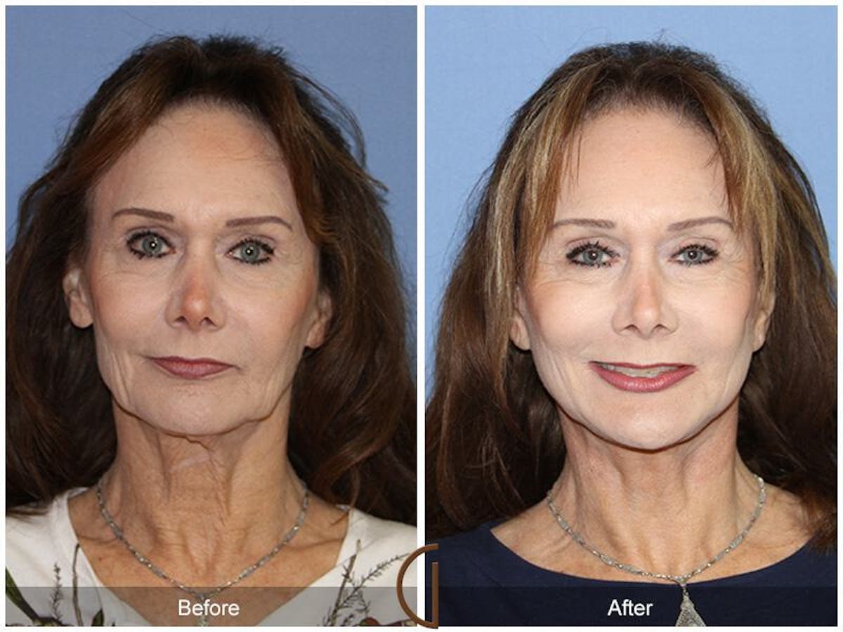 Facelift 60s Before & After Gallery - Patient 385684 - Image 2