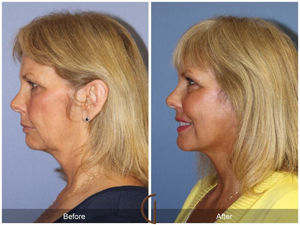 Facelift 60s Before & After Gallery - Patient 128015 - Image 1