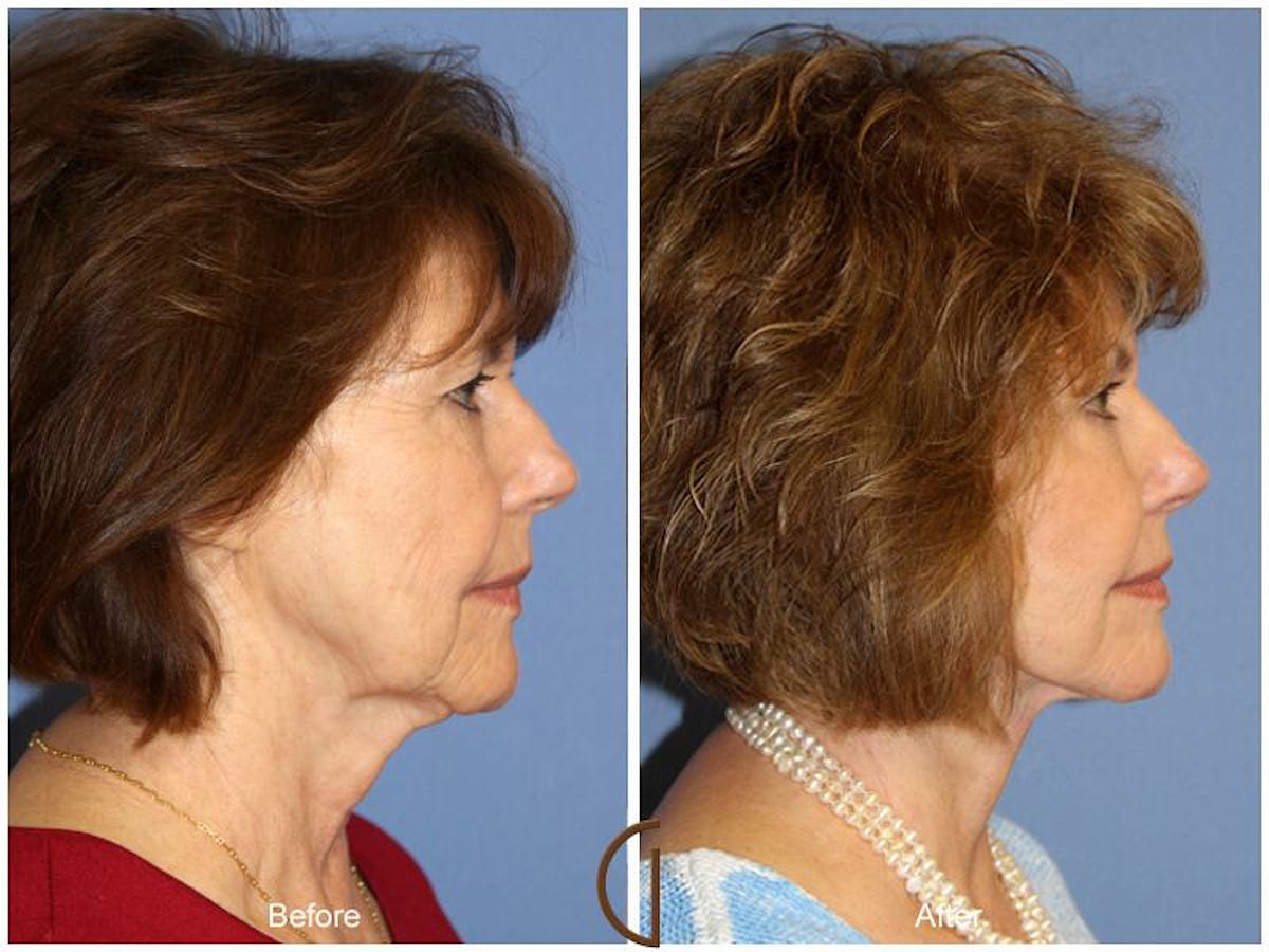 Facelift 60s Before & After Gallery - Patient 573048 - Image 3