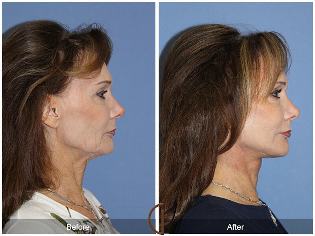 Facelift 60s Before & After Gallery - Patient 385684 - Image 3