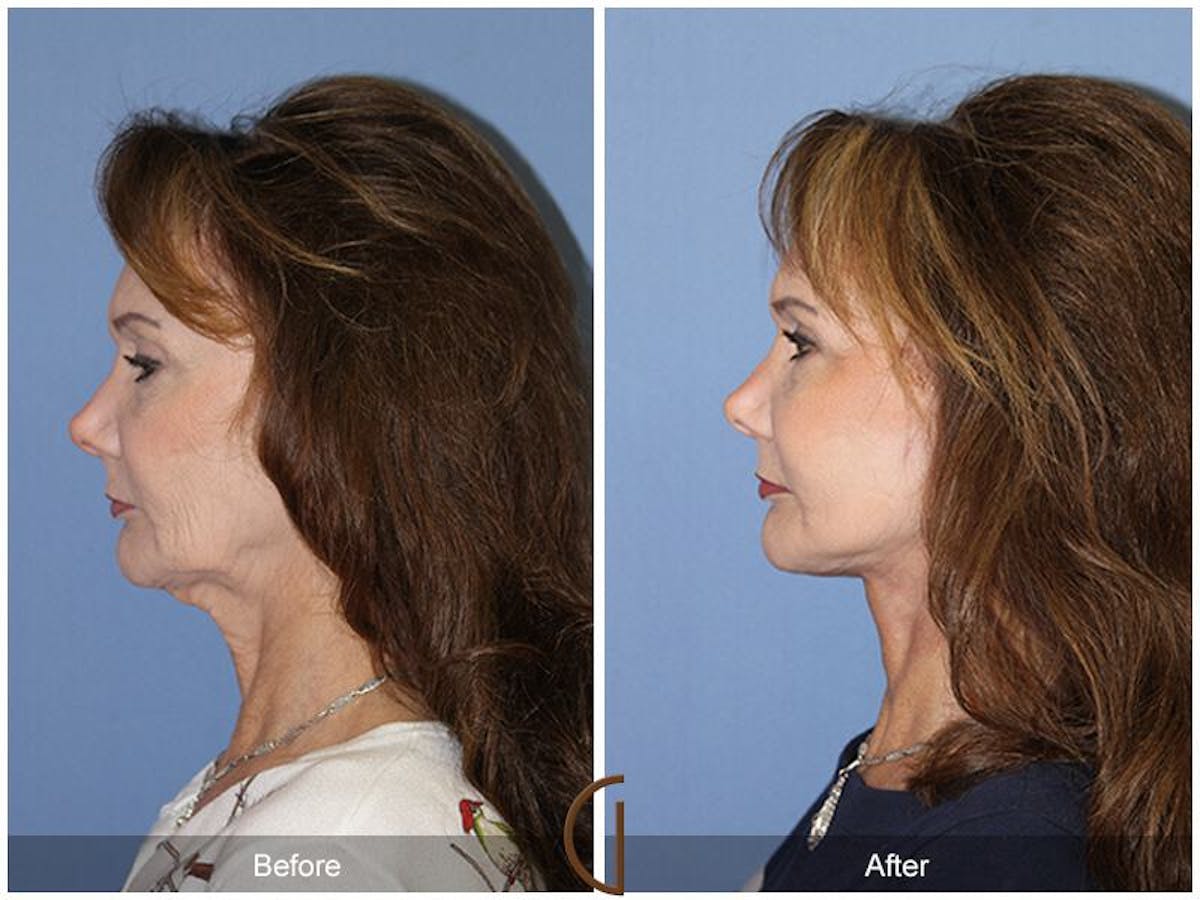 Facelift 60s Before & After Gallery - Patient 385684 - Image 1